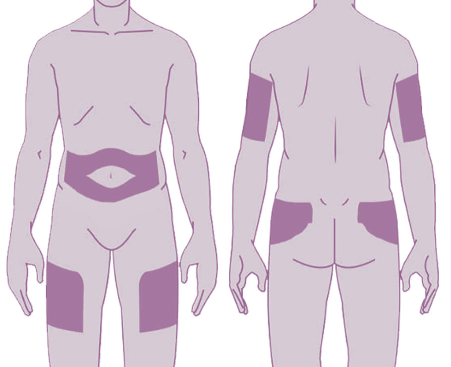 diagram of where Brixadi can be injected